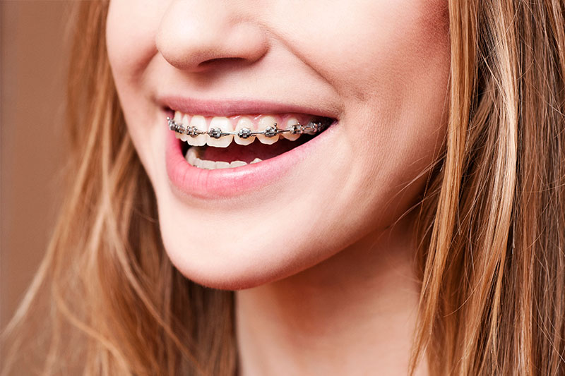 Orthodontics in Westchester, Los Angeles