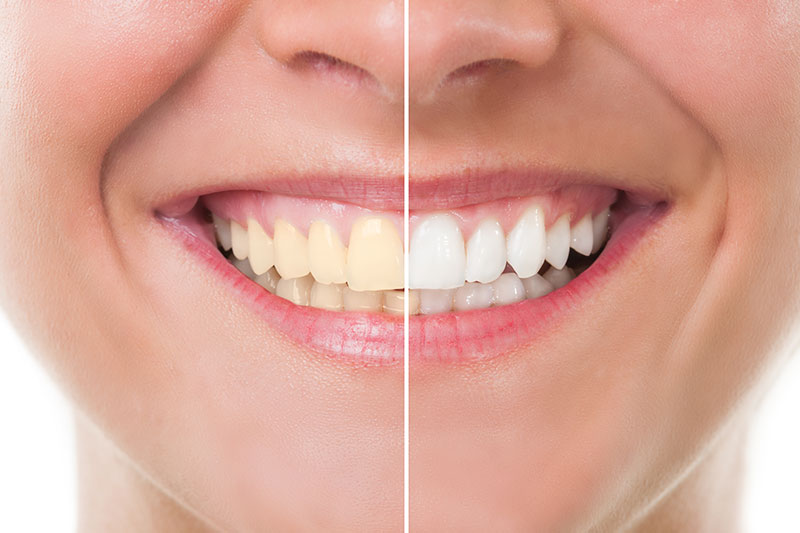 Teeth Whitening in Westchester, Los Angeles